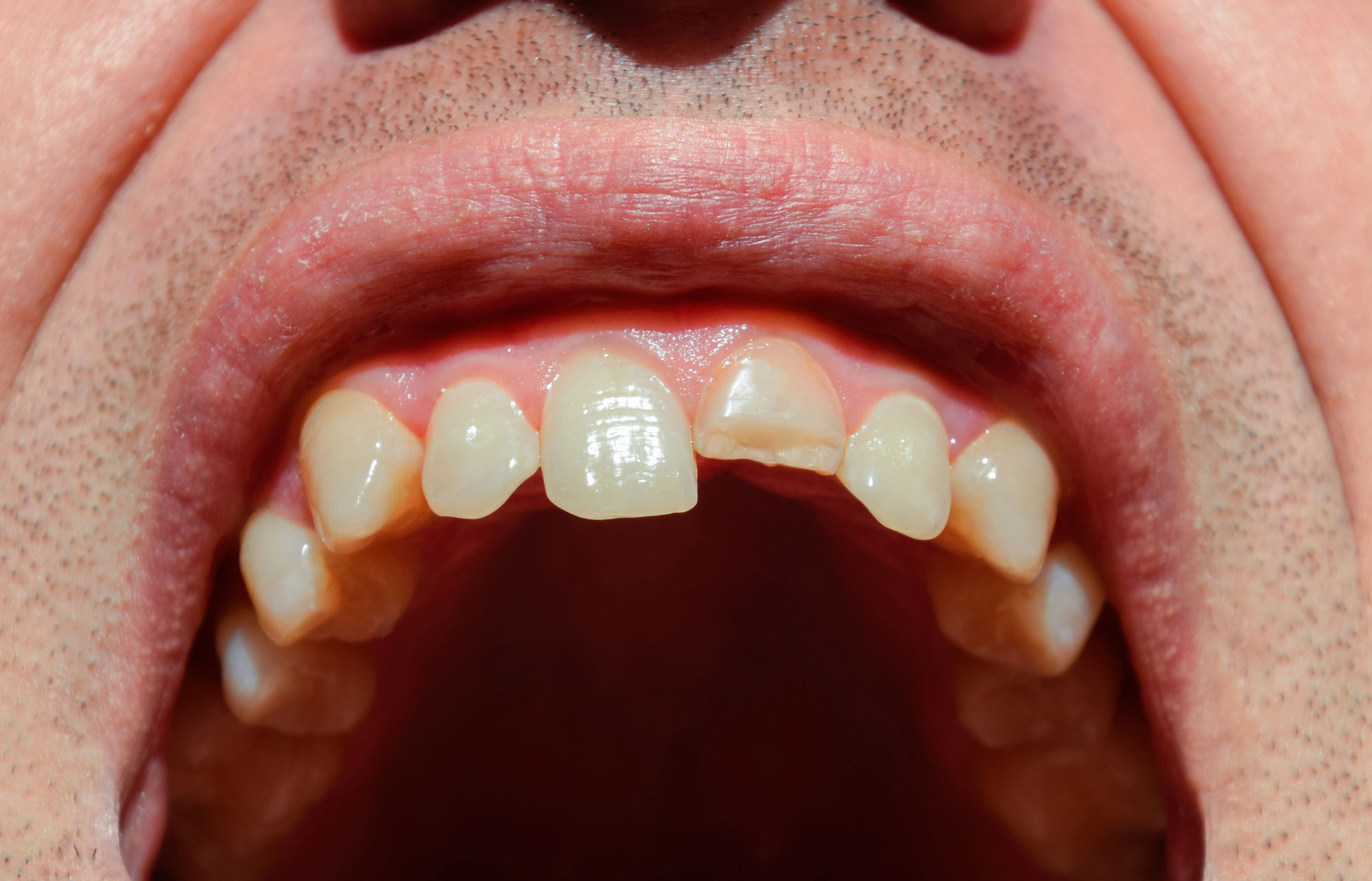 Broken-tooth.-Broken-upper-incisor-in-a-man-mouth