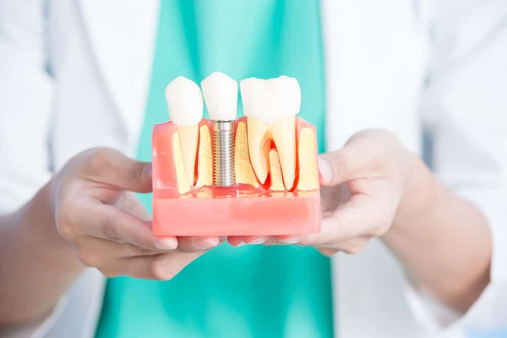 Close-up-of-dentist-holding-a-model-of-a-dental-implant-between-two-natural-teeth
