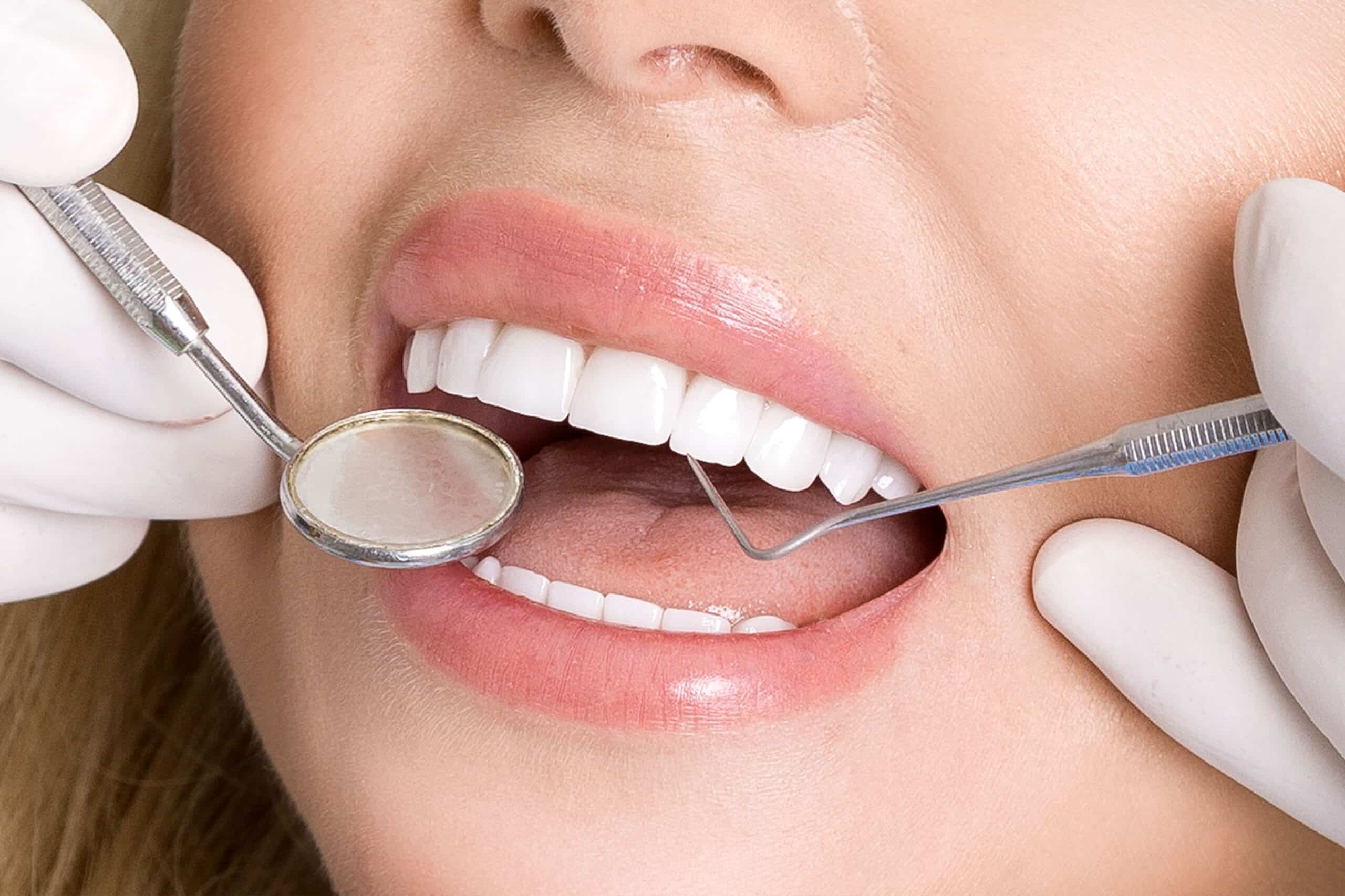 Close-up of dentist using tools on perfect teeth with veneers
