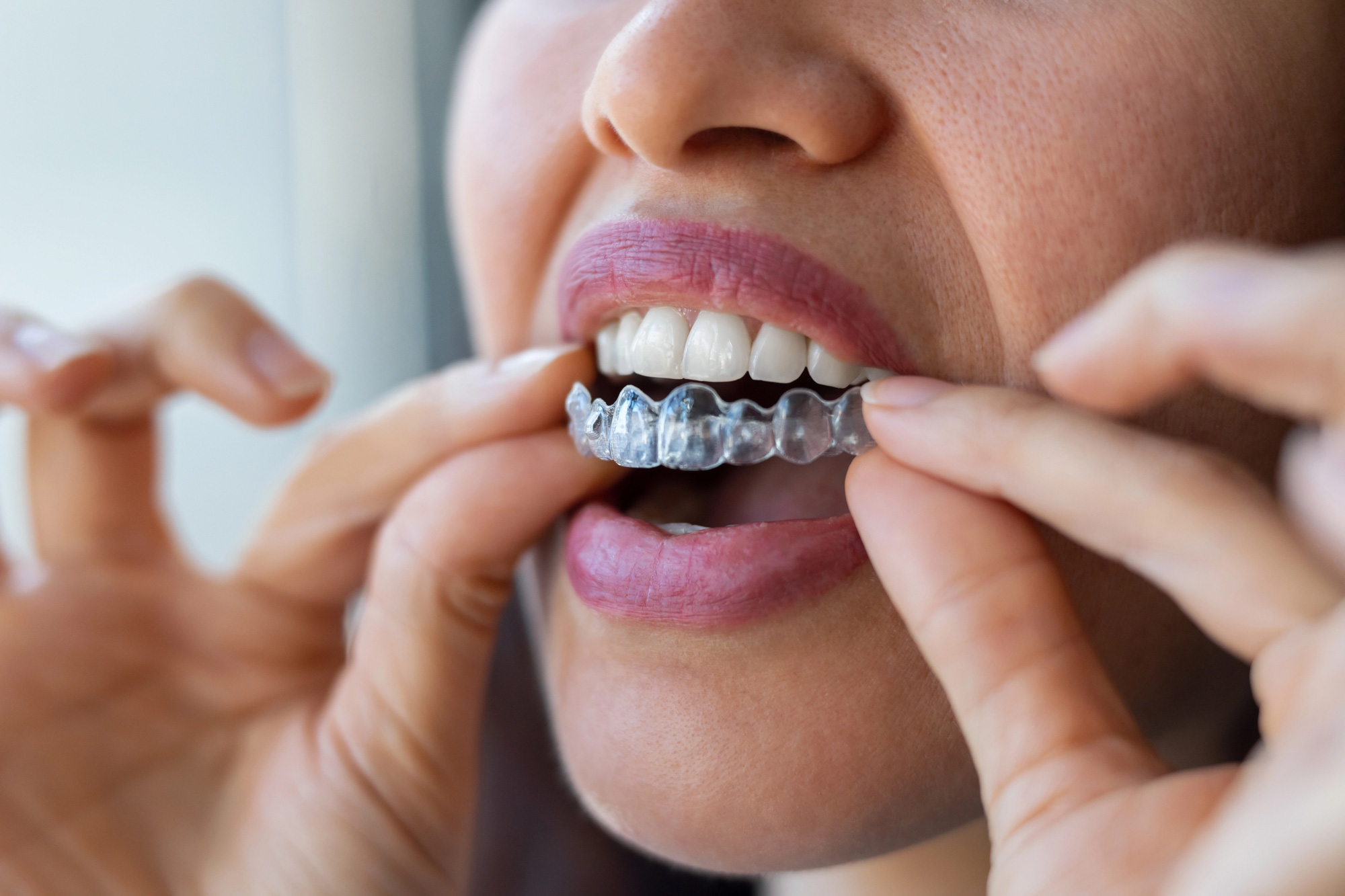 Close-up of woman wearing orthodontic silicone trainer