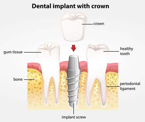 Dental Crown