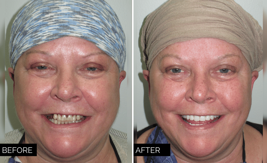 Dentures and Partials