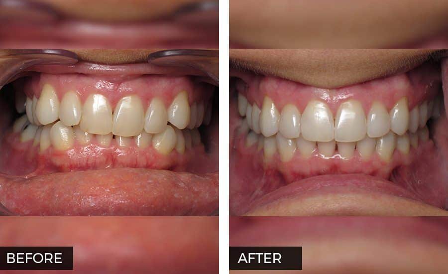 Invisalign