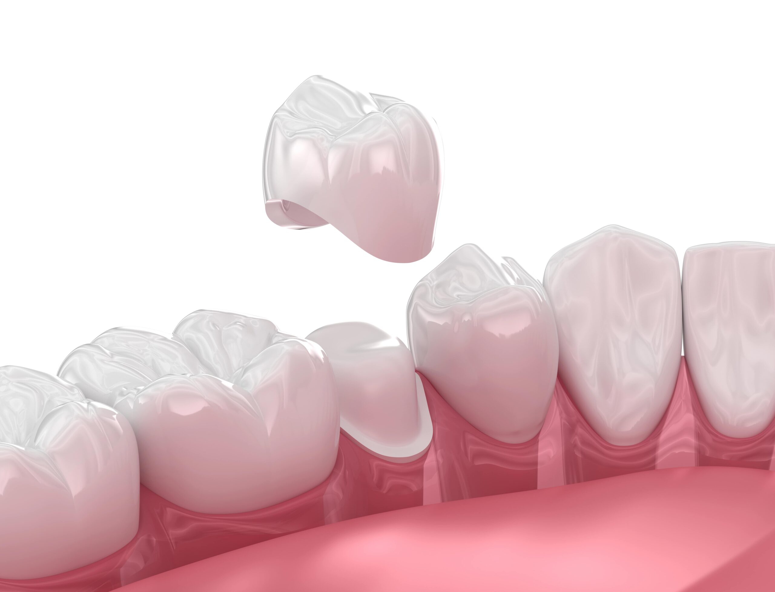 Medically accurate digital illustration of dental crown