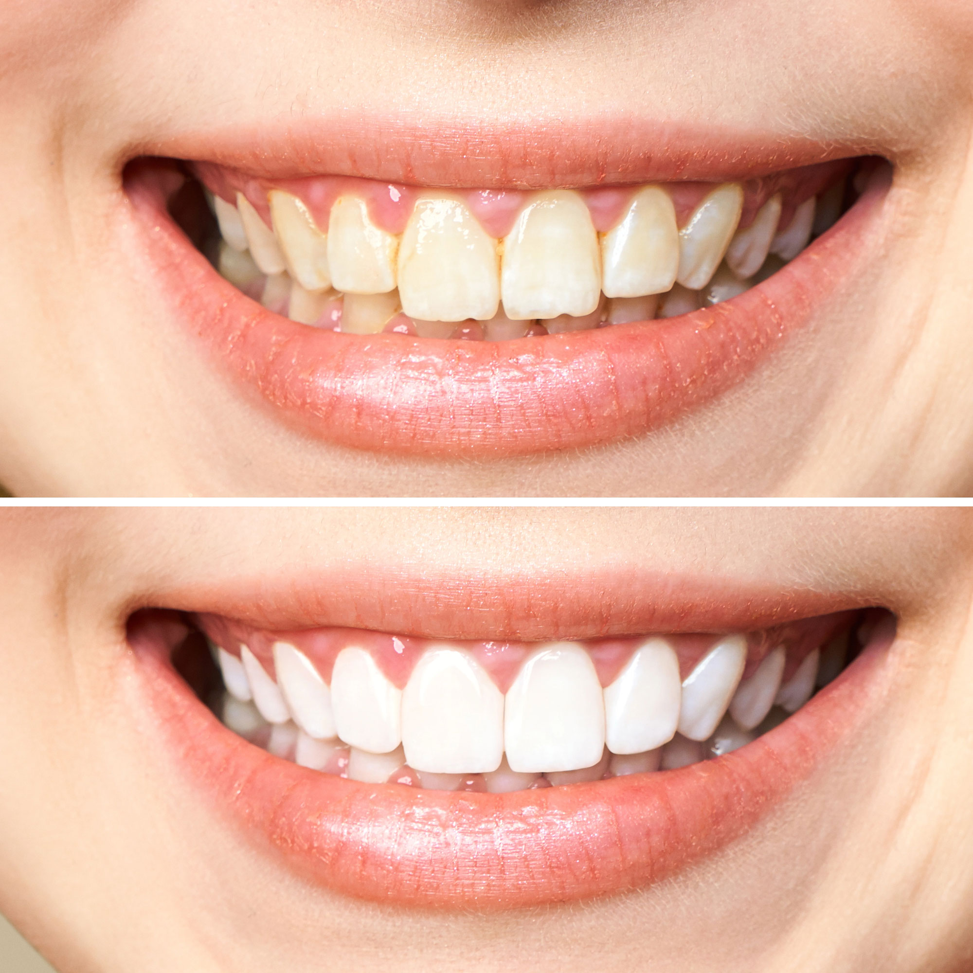 Woman-teeth-before-and-after-whitening