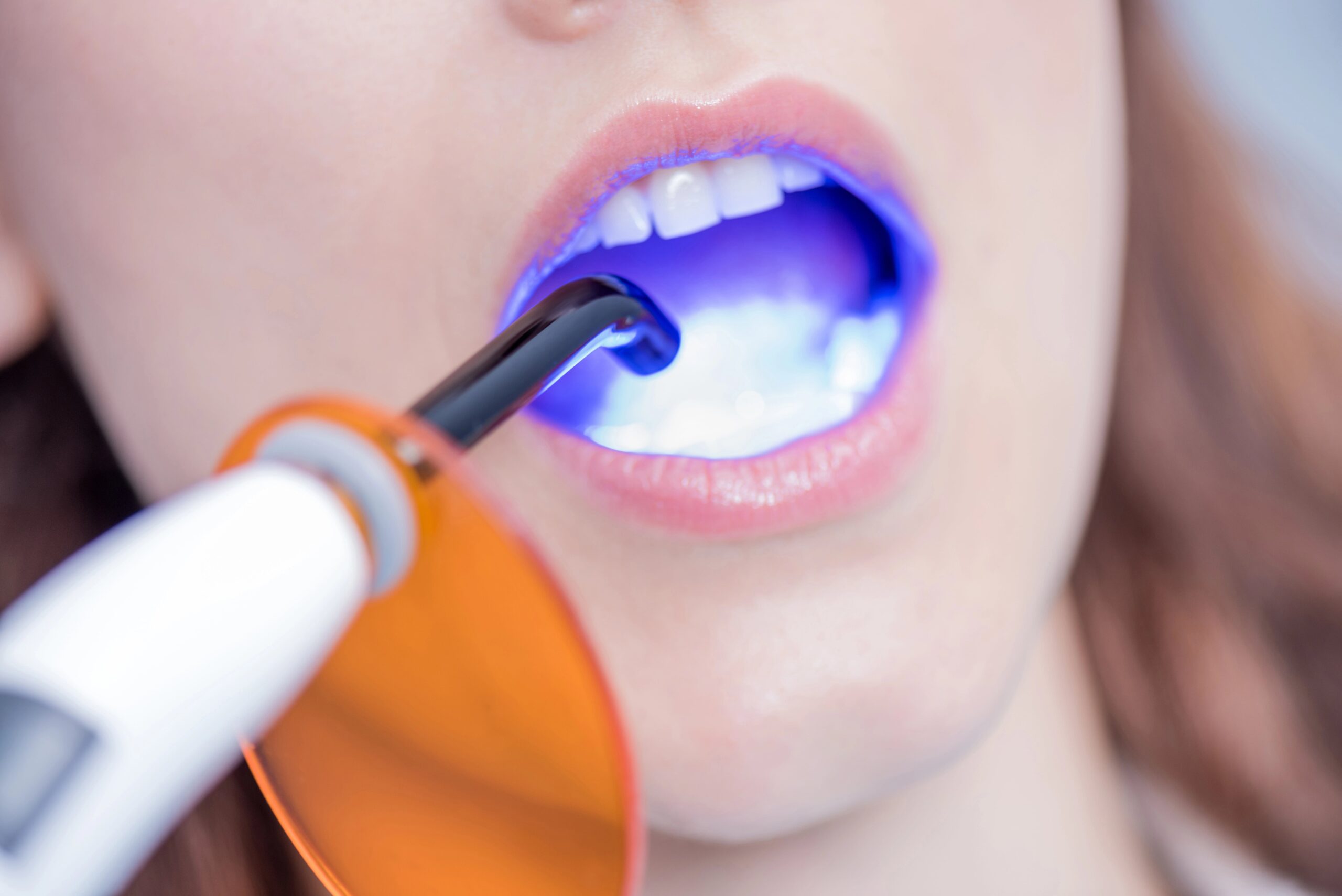 dental curing light for bonding