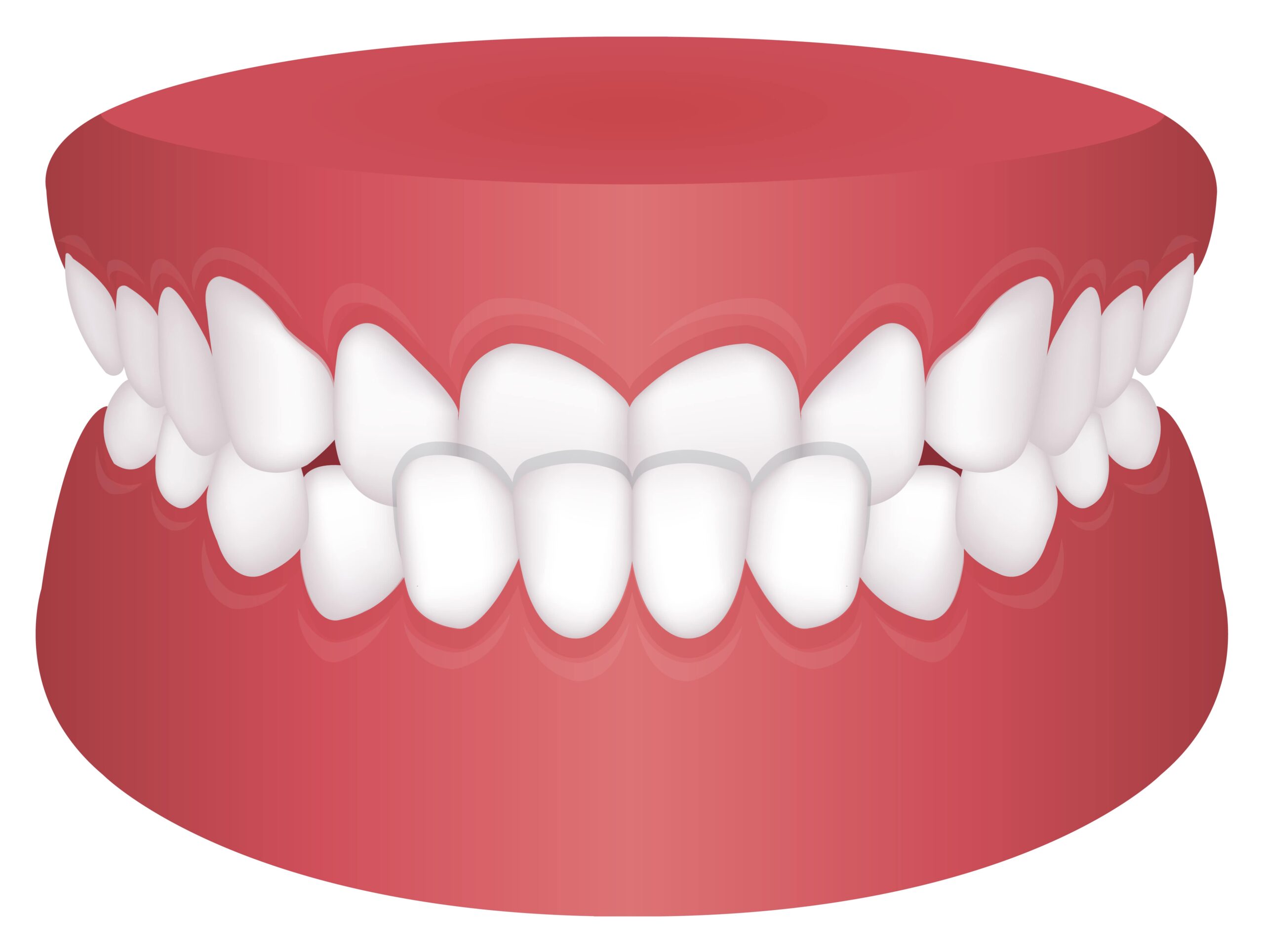 graphic illustration of underbite