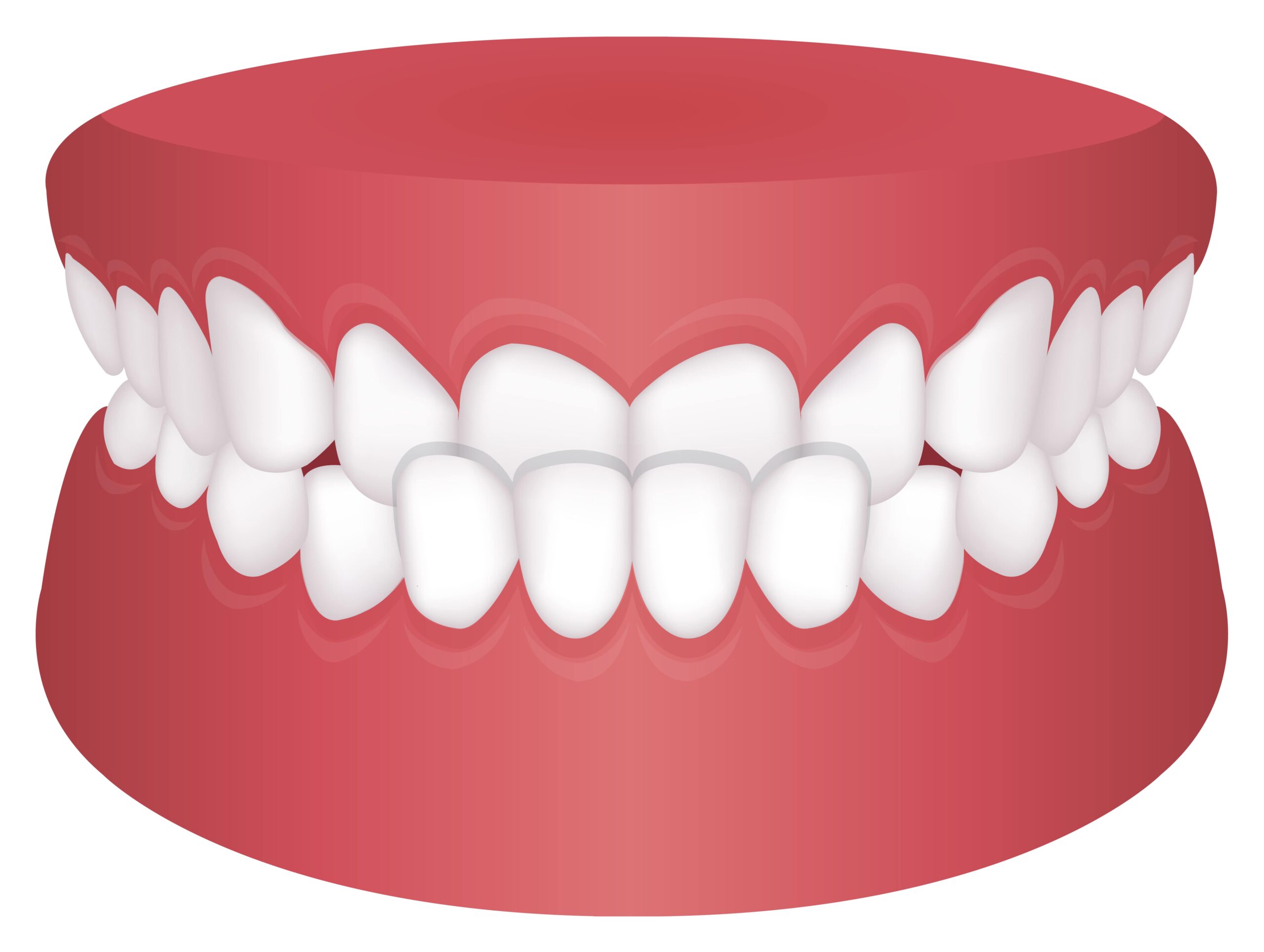 graphic illustration of underbite