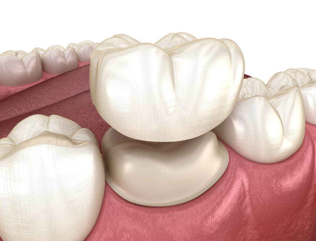 Digital illustration of dental crown