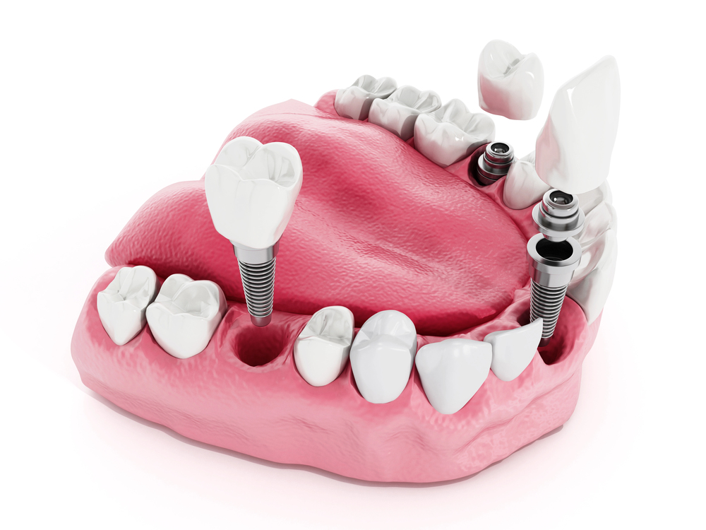 dental-implant-detail
