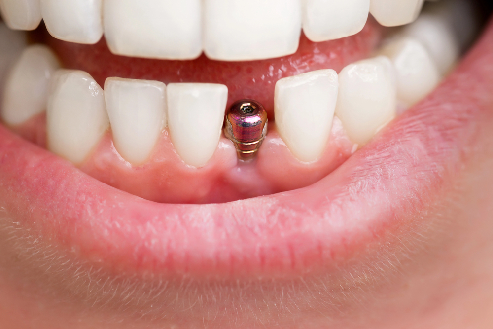 dentist-tools-beautiful-young-woman
